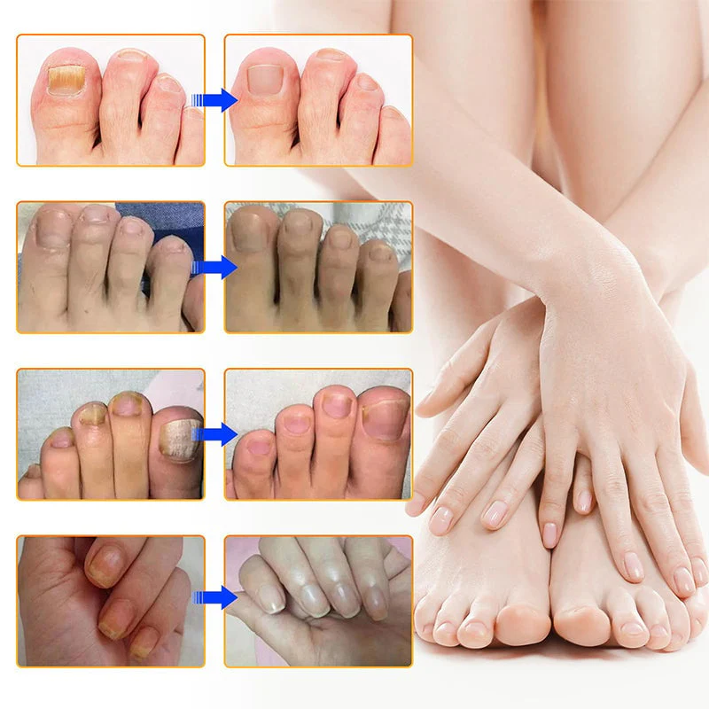 New Upsell - Fungal Nail Patches - Image 12