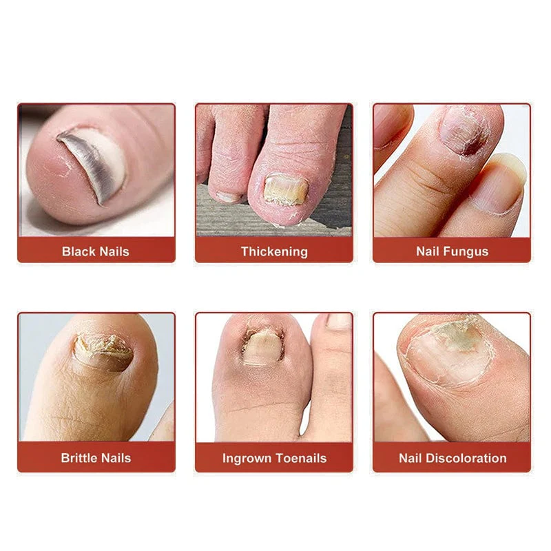 New Upsell - Fungal Nail Patches - Image 3