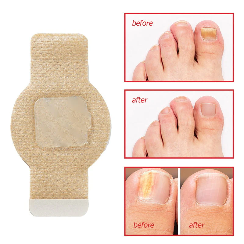 New Upsell - Fungal Nail Patches - Image 9